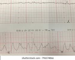 Image result for Non-Stress Test
