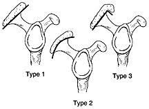 Classe bigliani (it) guardacoste classe bigliani, classe bigliani (guardacoste) (it). Painful Shoulder Impingement Syndrome Hc Chang Orthopaedic Surgery Singapore