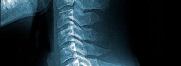 Check spelling or type a new query. Lesiones Deportivas En La Columna Cervical Entrevista Mba Blog