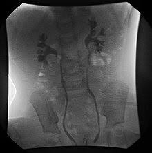 Vesicoureteral Reflux Wikipedia