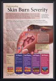 understanding skin burn severity chart 24x36 emt skin