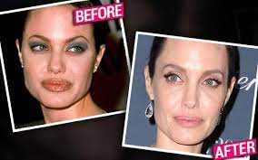 The actress has never confirmed that she's gotten a nose job, but multiple plastic surgeons have said that it looks like she's had a rhinoplasty . Angelina Jolie Had Conservative Nose Job Top Plastic Surgeons Claim