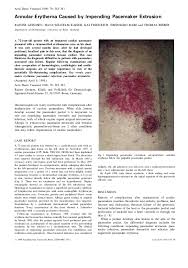 Image result for Cardiac Pacemaker Infection