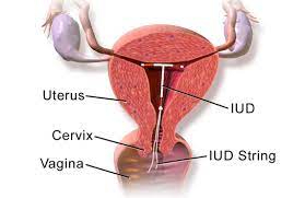 We did not find results for: Can I Get An Iud And Breastfeed Infantrisk Center