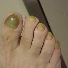 Image result for Yellow nail syndrome feet