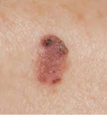It is not uncommon for a variety of different marks, such as moles and freckles, to develop as a result of sun exposure too. Spotting Skin Cancer