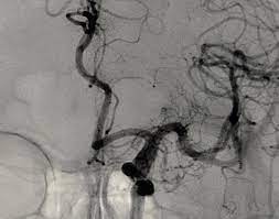 1 microemboli are observed to enter the middle cerebral arteries during coronary angiography. Cerebral Angiography