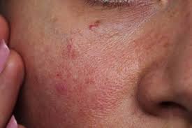 We all know when our skin is red for a reason that makes complete sense. 9 Best Diy Face Masks For Reduce Redness Natural Homemade Recipes End Uses Mask Natural