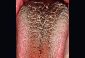 Image result for brown tongue symptoms