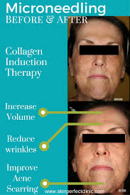 Maybe you would like to learn more about one of these? Pin On Microneedling