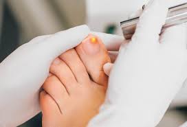 Always cut your toenails short. How I Zapped Away My Toe Fungus Peach Skin Laser Laser Center Medispas