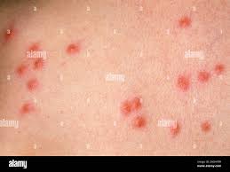 Image result for flea bite