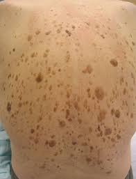 Image result for Melasma