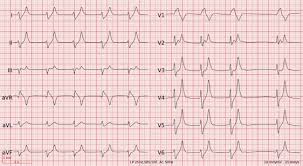 Quadruple nosepiece revolves on ball bearing. Ecg Of The Month A De Winter Like Ecg Pattern In A Patient Presenting With Progressive Lethargy Annals Of Emergency Medicine