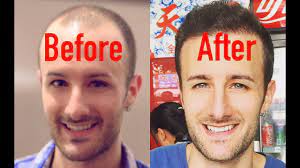 About 60 percent of men and. Entire Hair Transplant Surgery Video Beginning To End Youtube