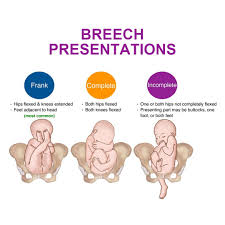 Image result for Breech Delivery