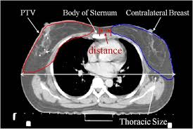 Maybe you would like to learn more about one of these? Secondary Cancer Risk After Radiation Therapy For Breast Cancer With Different Radiotherapy Techniques Scientific Reports