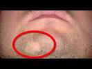 Beard Hair Loss Fungus
