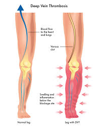 Image result for BLOOD CLOT IN THE LUNGS AND LEGS