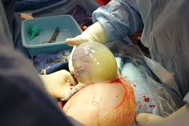 En Caul Delivery Babymed Birth Photography Birth Education Water Birth