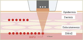 Illustration explaining how HIFU targets deeper SMAS layers for non-surgical lifting