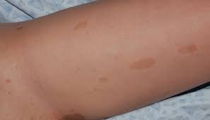 What's more, they're rarely cause for concern and aren't usually treated. Cafe Au Lait Macules Dermatology Advisor