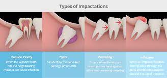 Wisdom teeth can also be affected—they are packed within softer tissues and jawbone, or cracked or expelled just slightly via the gums. Wisdom Tooth Extraction Removal In Bangkok Thailand