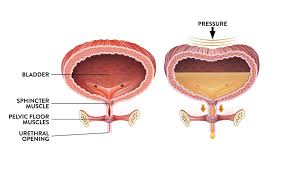 Image result for Urinary Incontinence