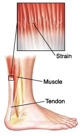 A tendon is tissue that attaches muscle to the bone. When Your Child Has A Strain Sprain Or Contusion
