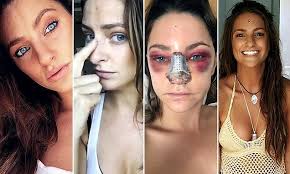 Meet The Woman Sharing Her Nose Job Journey On Social Media Nose Job Nose Contouring Nose Job Recovery