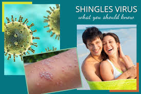 Image result for shingles