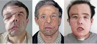 First face transplant patient, a french woman, dies. Man With 3 Faces Frenchman Gets 2nd Face Transplant