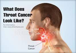 Getting treatment early improves your odds of better outcomes. What Does Throat Cancer Look Like Survival Rates Of Throat Cancer