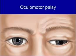 Image result for Pupillary Paralysis