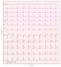 This is manifested as an upright p wave in lead ii of the ecg. Ecg Interpretation Characteristics Of The Normal Ecg P Wave Qrs Complex St Segment T Wave Ecg Echo