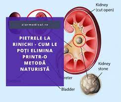 Tratament pentru pietre la rinichi. Pietrele La Rinichi Simptome Si Tratament Naturist Ziarmedical Ro