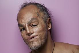 How the boy with no face learnt to smile