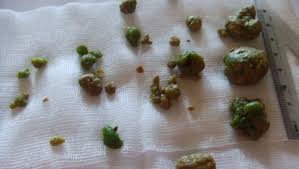 Cat dureaza regimul in principiu, regimul alimentar se tine in perioadele cu simptome, dar daca acestea sunt frecvente, repetate, se recomanda ca alimentele mentionate sa fie evitate. Iata Ce Poti Sa Mananci Daca Ai Pietre La Fiere Buna Ziua Iasi Bzi Ro