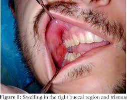 Image result for phlegmon on face)