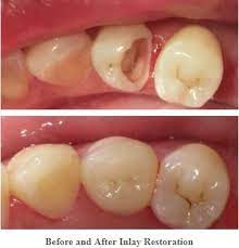 How Long Can Porcelain Inlay Last Dental Fillings Tooth Filling Dental Restoration