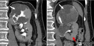 Cystic Nephroma Two Images Are Coronal Reconstructions From A Contrast Enhanced Ct Urogram Demonstrating A Cystic Mass In The Uppe Kidney Mass Radiology Renal