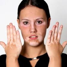 Image result for Vitiligo