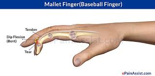 Mallet finger, also known as baseball finger, is an injury to the thin tendon that straightens the end joint of a finger or thumb. Mallet Finger Mallets Finger Injury Finger