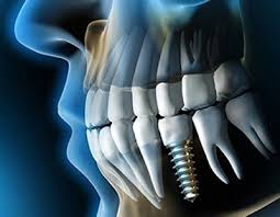 How many days you do peridex (chlorhexidine gluconate) mouthwash after simple dental implant on 2 upper molar teeth. Dental Implants Aspen Hill Md Missing Teeth Dentures