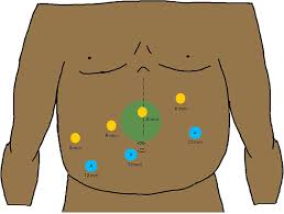 Image result for Venous Hum