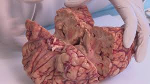 Here, the top two images show a normal brain. Research On Cte Dissection Of Football Players Brains Youtube