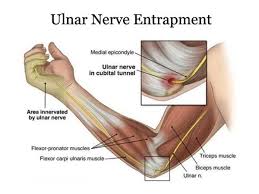 5 Elbow Overuse Injuries That Is Preventing You From Doing The Things You Love To Do Ulnar Nerve Nerve Entrapment Ulnar Nerve Entrapment