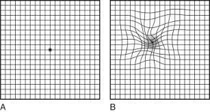 Amsler Grid An Overview Sciencedirect Topics