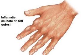 Acid organic care se gaseste in urina si in sange, rezultat din arderea proteinelor. Ce È™tiÈ›i Despre GutÄƒ Cu SiguranÈ›a MulÈ›i Dintre Voi SuferiÈ›i De AÈ™a Ceva Doar Ca Nu Stiti Ce Este Pai HaideÈ›i Sa Va Explic Eu Guta Este O Afectiune Ce Cauzeaza