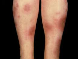 The reactive arthritis duration can vary from a few weeks to a year. Reactive Arthropathy Dermnet Nz